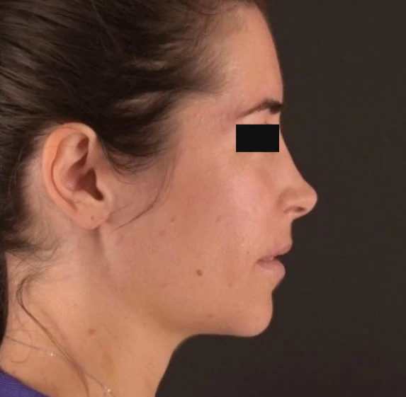 After treatment, case 03