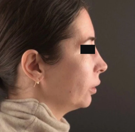 Before treatment, case 03