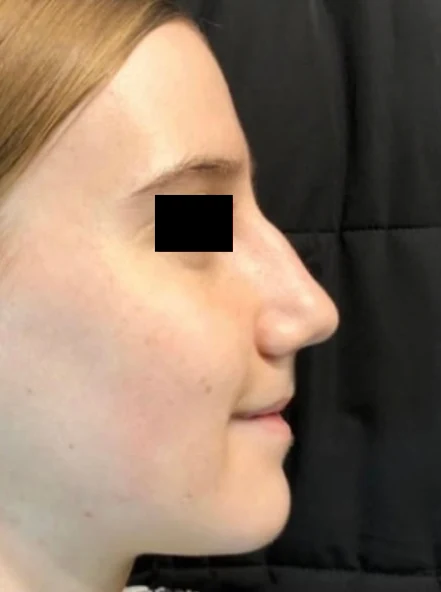 After treatment, case 05