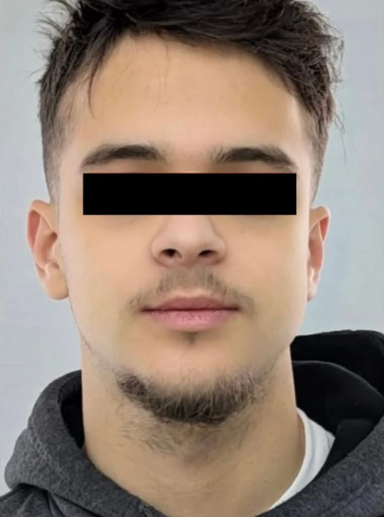After treatment, case 06